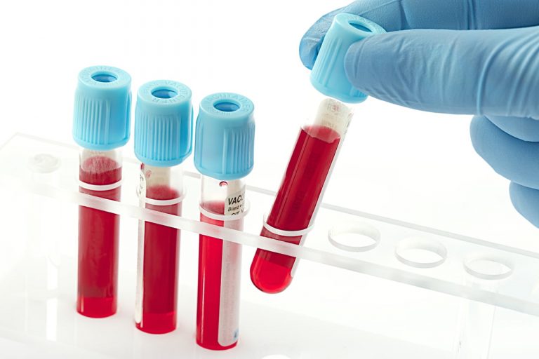 À quoi servent les mesures d’hématocrite ? Anorexie Bretagne